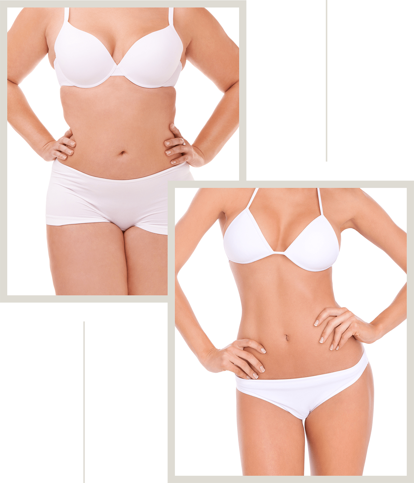 Before and after body contouring.