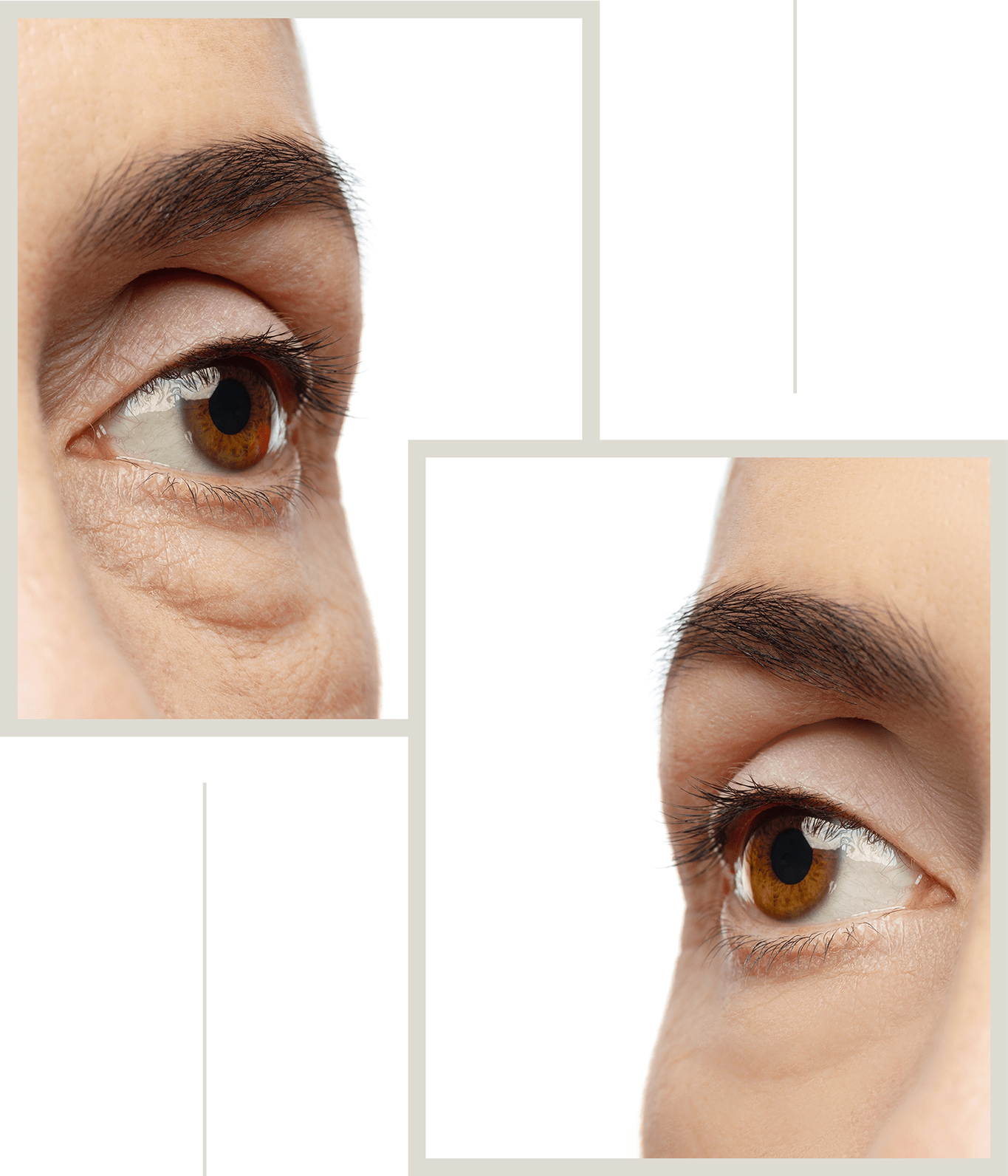 Before-and-after images of eyelid surgery.