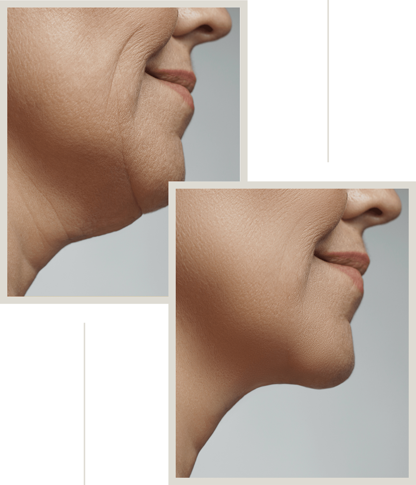 Before and after a face & neck lift.